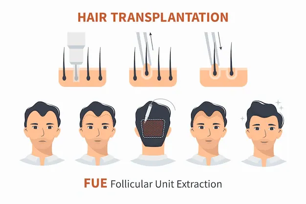 Schéma de la technique FUE — extraction folliculaire unité par unité