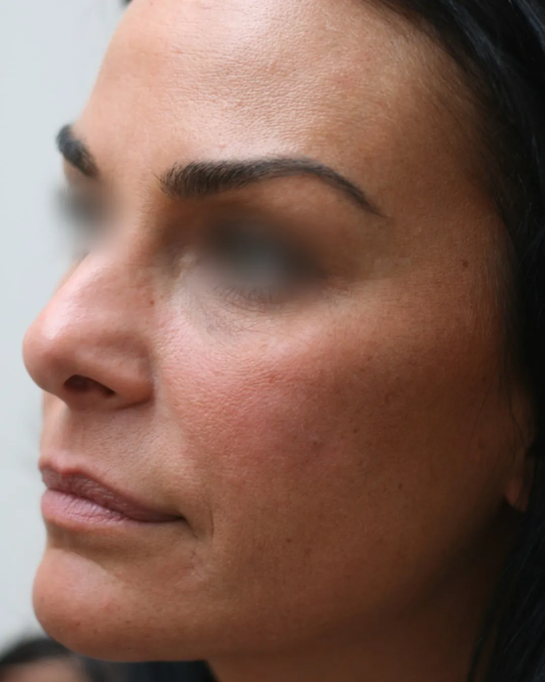 Après — Injections full face