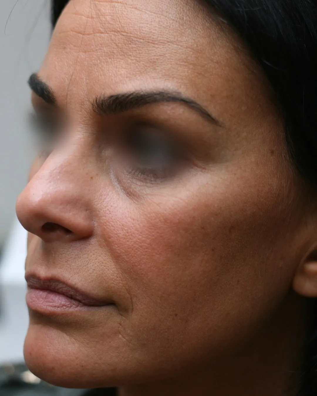 Avant — Injections full face